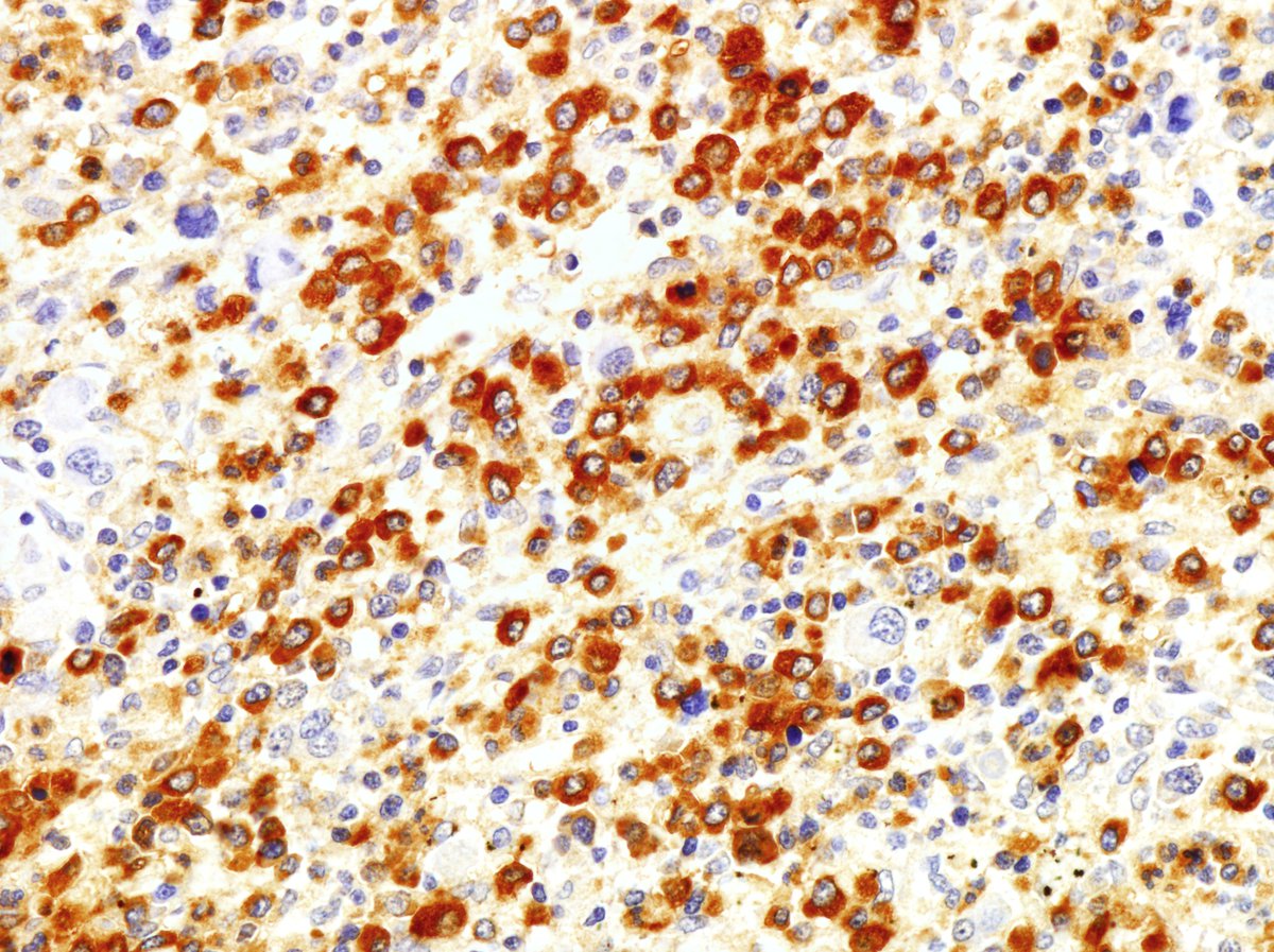 Spleen, splenectomy (1998, submitted): The immature myeloid cells were positive for MPO. An increased number of CD34-positive myeloid blasts were identified by flow cytometric analysis further supporting a diagnosis of early transformation.  